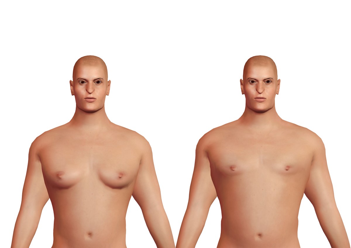 Gynecomastia and physiological breasts in men